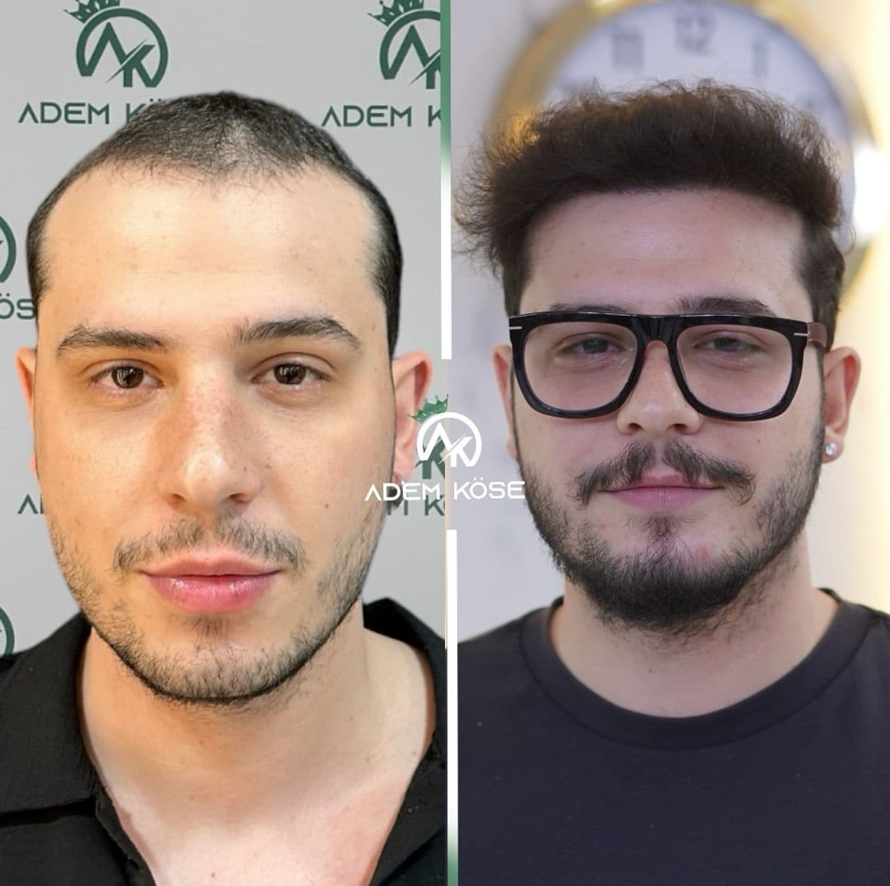 Ahmet Kul — Before / After